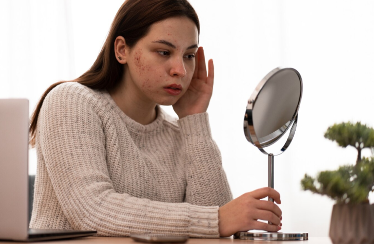 Stress and Acne: The Connection and Solutions